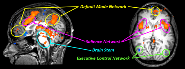 This image shows a brain scan with colored highlights indicating three key brain networks. The image includes both a sagittal (side) view on the left and what appears to be an axial (top-down) view on the right. The three networks are labeled with colored text and circles marking their locations: "Default Mode Network" (yellow text/circles) - highlighted in orange/red areas in upper and posterior regions of the brain "Salience Network" (purple text/circles) - highlighted in red areas primarily in the middle sections of the brain "Executive Control Network" (green text/circles) - highlighted areas in lower portions of the brain There's also a cyan label pointing to the "Brain Stem" at the bottom of the sagittal view. The underlying image is a grayscale brain scan with colorized regions of activity or structural emphasis, showing how these networks are distributed throughout different brain regions.